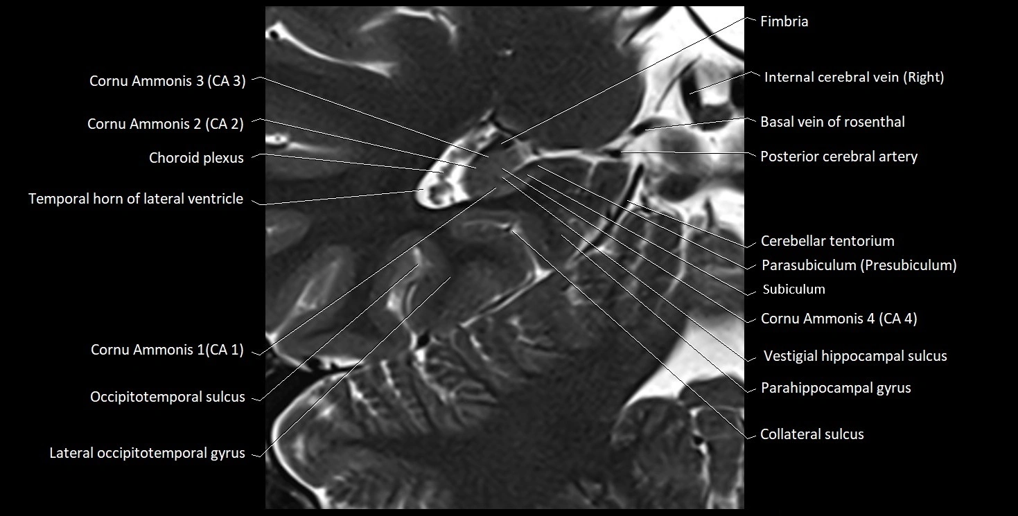 Hippocampus anatomy mri coronal cross section 3T MRI image 16.webp
